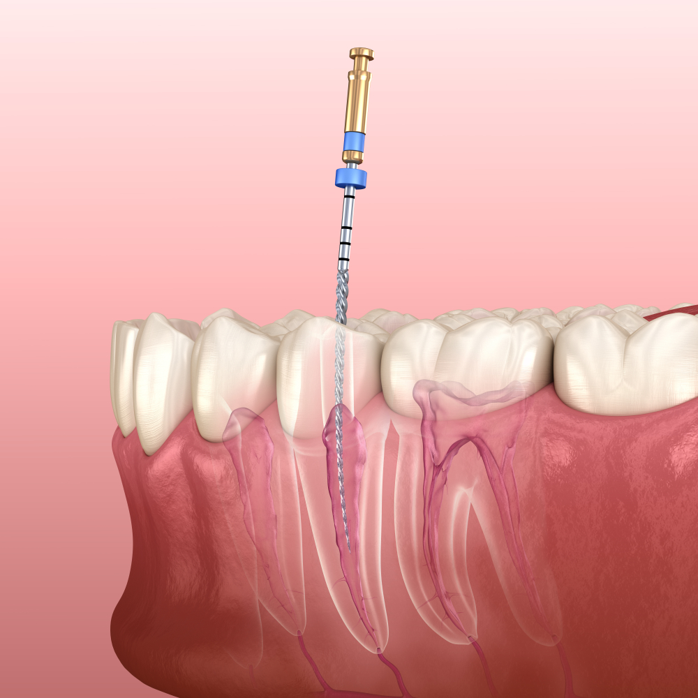 ენდოდონტიური მკურნალობა თანამედროვე სტომატოლოგიაში