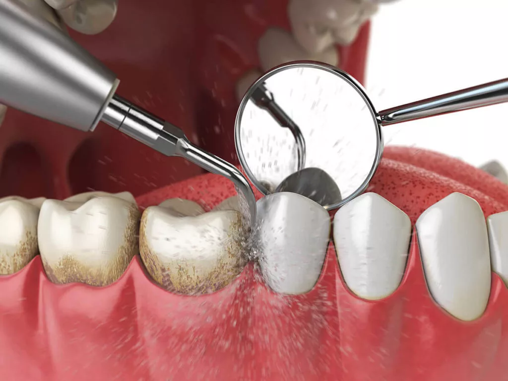 how can Professional teeth cleaning help us