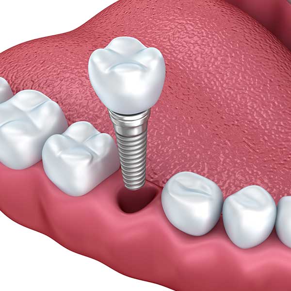 secalgarydentalimplantshealthplusdental_1678978948.jpg